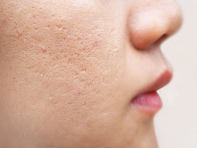 Maximize Device Options for Acne and Acne Scarring