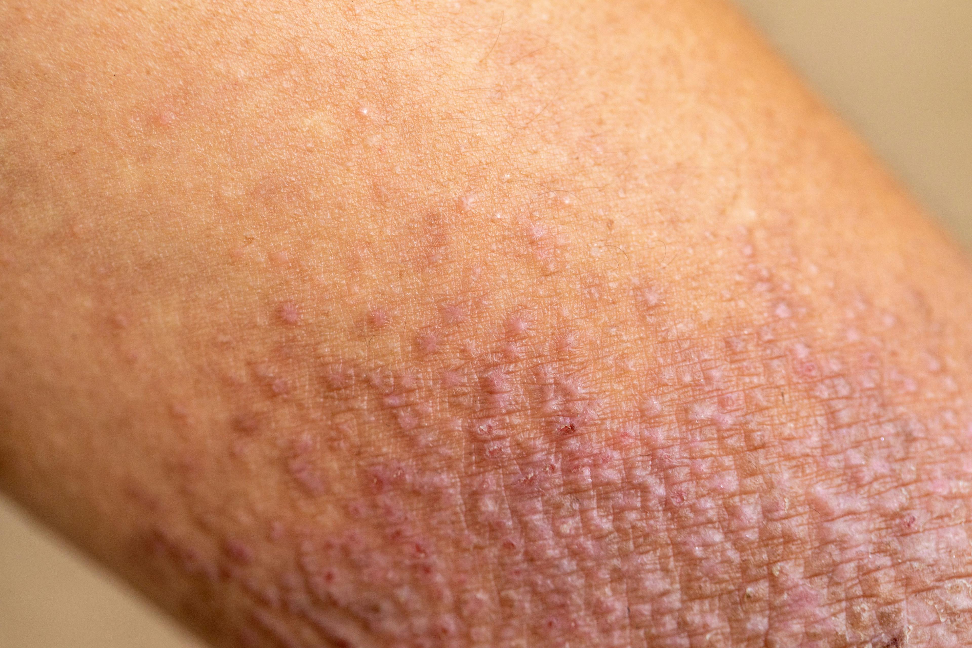 Eczema Lesion Detection Increased With EczemaNet2 Automated Assessment
