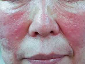Estrogen, Hormone Changes Play Role in Rosacea and Skin Alterations, Study Finds