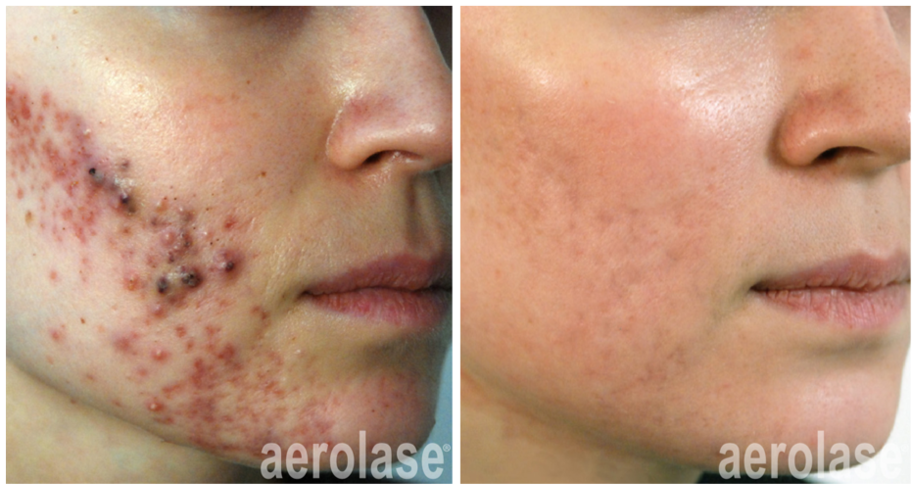 Neoderm by Aerolase